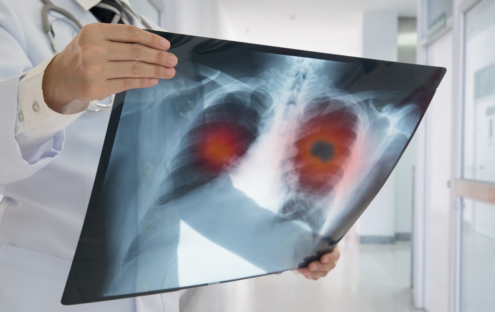 doctor looking at a lung xray